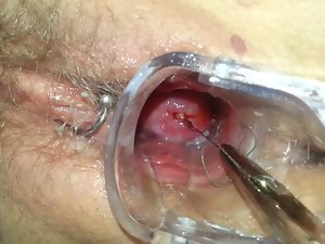 Mirena Spirale ziehen penyingkiran IUD IUP entfernen